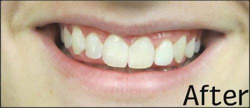 After invisalign and whitening