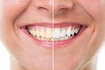 Top 5 Benefits of Teeth <br>Whitening