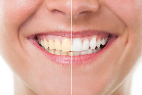 Top 5 Benefits of Teeth Whitening