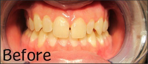 Before invisalign and whitening