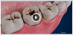 Dental Caries