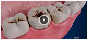 Dental Caries