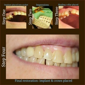 Dental Implants: Types & Benefits, Lewis Center