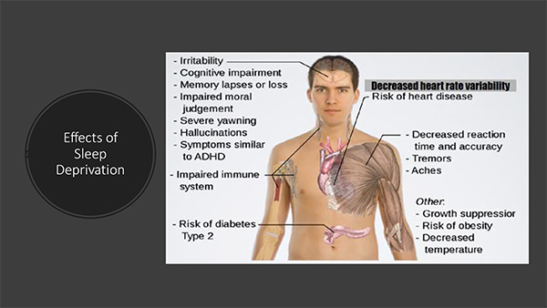 Sleep Apnea