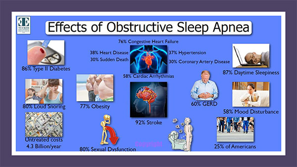 Sleep Apnea